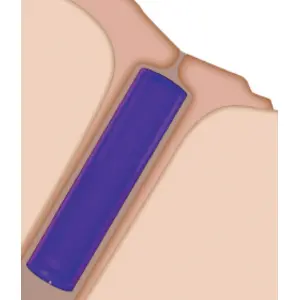SOFT PLUG Extended Duration 180 Canalicular Plugs