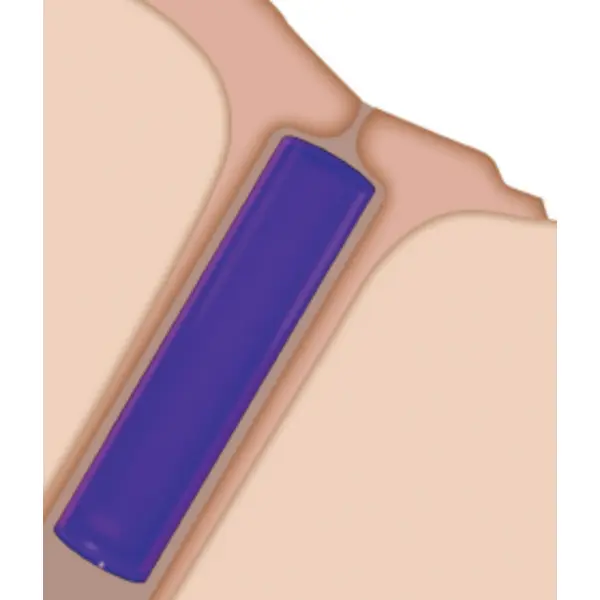 Soft Plug Extended Duration 180 Canalicular Plugs