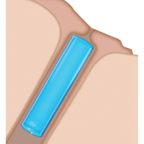 Soft Plug Extended Duration Plugs