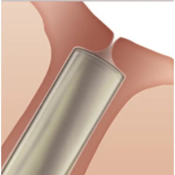 SOFT PLUG Collagen Plugs
